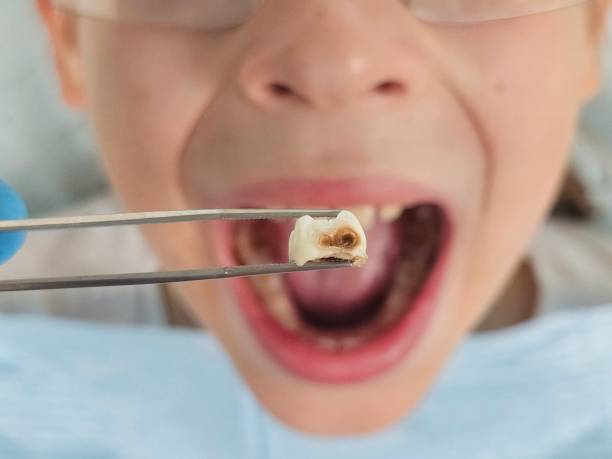 Best Emergency Root Canal Treatment in Mulvane, KS